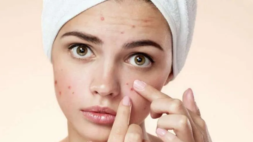 Common Pimple Mistakes 