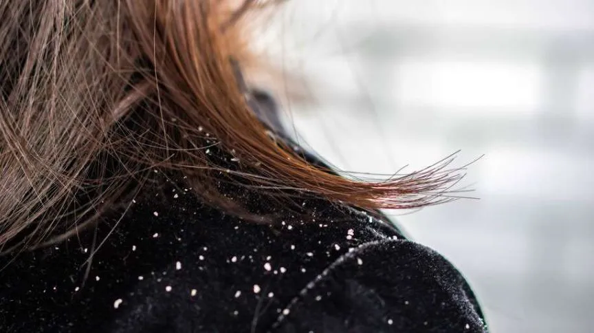 Dandruff Tips: घरेलू नुस्खों से सर्दियों में डैंड्रफ से छुटकारा