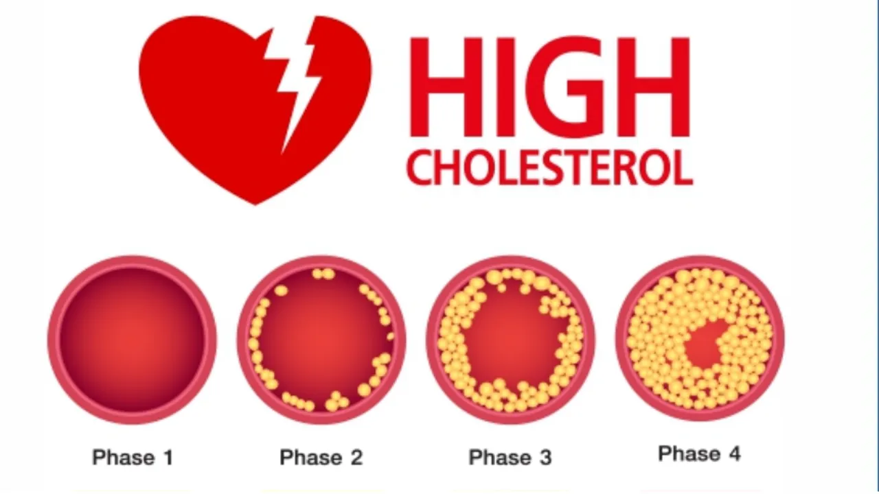 Control Cholesterol: जाड़ों में कैसे नियंत्रित करें बढ़ता कोलेस्ट्रॉल