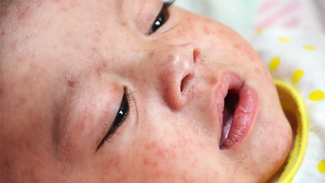 Measles Outbreak In Mumbai: कैसे रखें बच्चों का ध्यान, जाने लक्षण