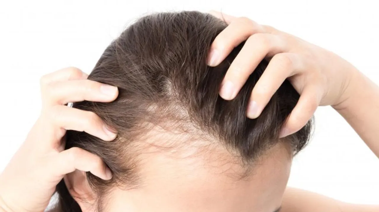 Female Pattern Baldness: महिलाओं में तेजी से झड़ते बालों का कारण