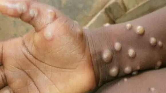 5 Commonly Asked Questions About Monkeypox: यहां हैं जवाब