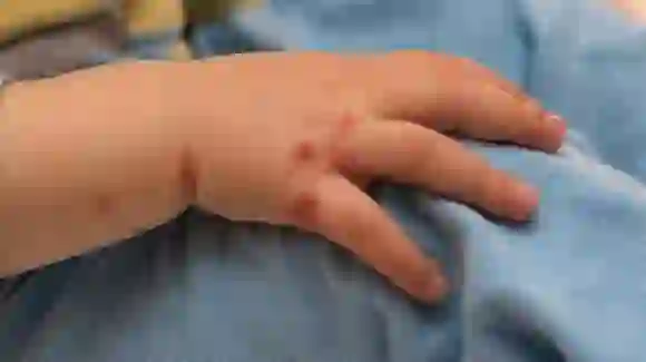 New Skin Disease: क्या है हाथ, पैर और मुंह रोग? बच्चों के लिए है खतरा