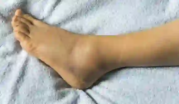 Home Remedies For Swollen Feet: पैरों में सूजन आने का क्या कारण है और उसके घरेलू उपाय