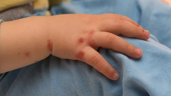 New Skin Disease: क्या है हाथ, पैर और मुंह रोग? बच्चों के लिए है खतरा