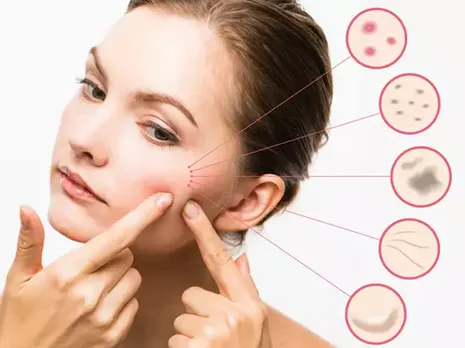 Reasons Of Pimples: हेरिडिटी और स्ट्रेस, जाने मुहाँसों के 7 कारण