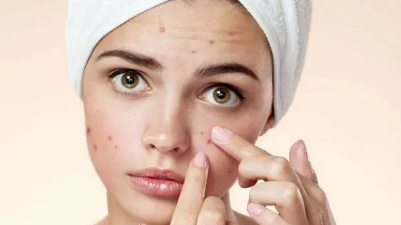 Common Pimple Mistakes: पिंपल हटाने के लिए ना करें यह गलतियां