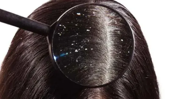 Hair Pack For Dandruff: ये हेयर मास्क डैंड्रफ को खत्म करे जड़ से