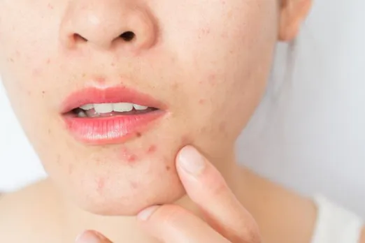 Home Remedies For Pimple : आज़माए ये 5 घरेलु नुस्खे और पिम्पल को कहें बाय बाय
