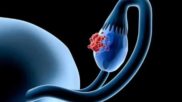 Ovarian Cancer: जानिए क्या है ओवेरियन कैंसर और इसके लक्षण?