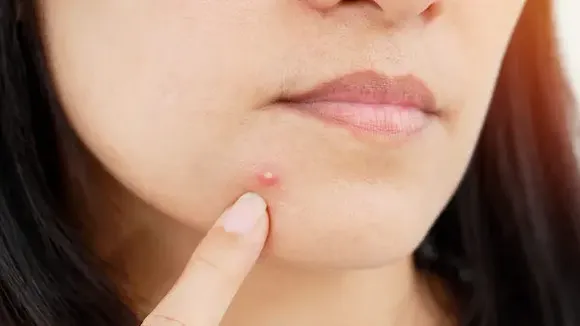 How To Get Rid Of Pimples? गर्मियों में चेहरे का ऐसे रखें खयाल