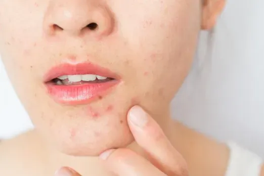 Tips For Pimples: इन 6 टिप्स से आप पा सकती हैं पिंपल से छुटकारा